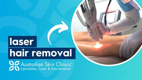 laser hair removal bluewater|Iba pa.